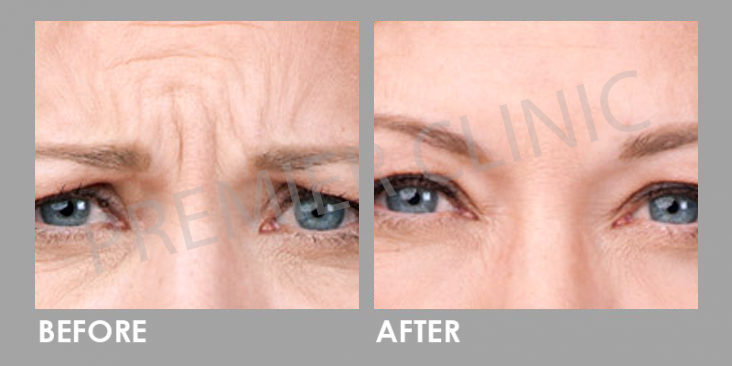 Before & After Botulinum Toxin