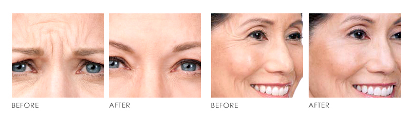 Xeomin Botulinum Toxin 