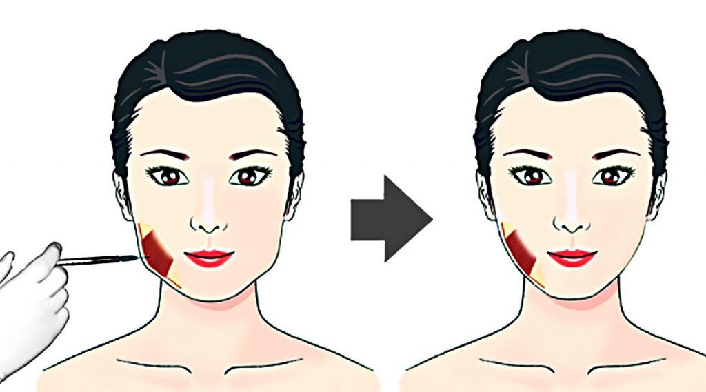 BENEFITS OF BOTULINUM TOXIN
