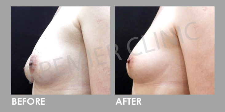 Breast Botox Before After