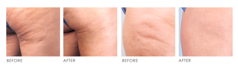 CELLULITE Before After