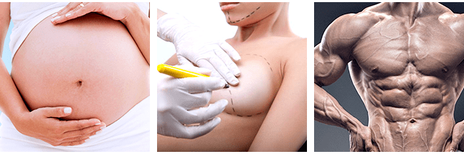 Causes of Stretch Marks