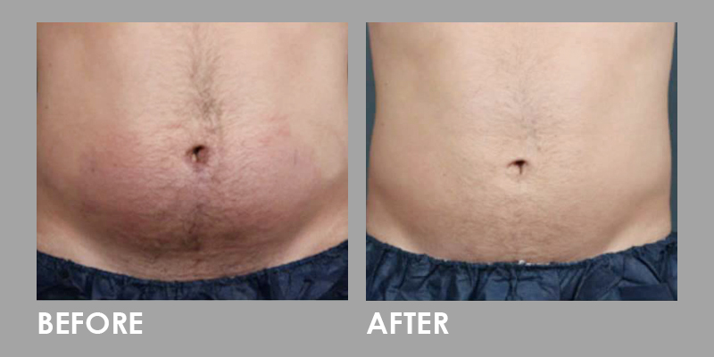 clatuu fat freezing