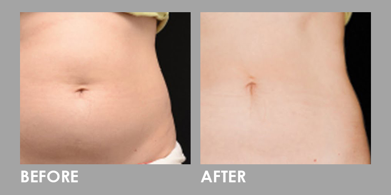clatuu fat freezing