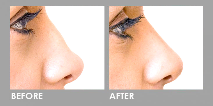 Derma Filler Before After 