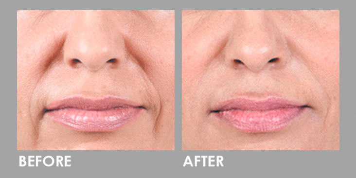 Derma Filler Before After 
