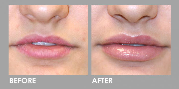 Derma Filler Before After 