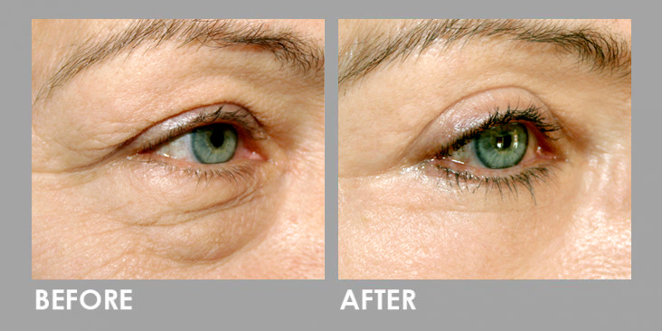 Derma Filler Before After 