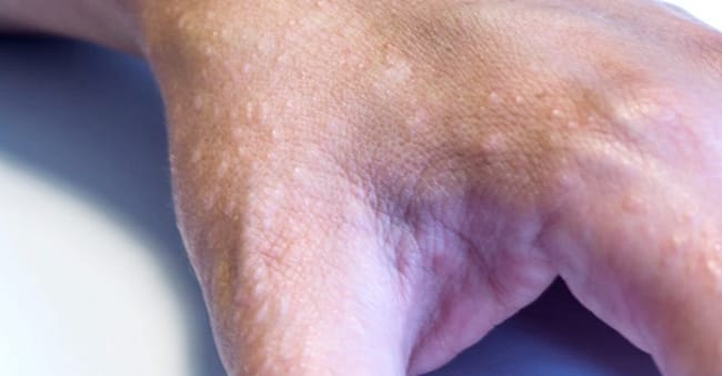 Dyshidrotic eczema