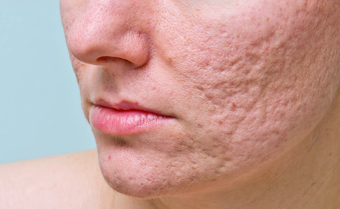Depressed Acne Scars