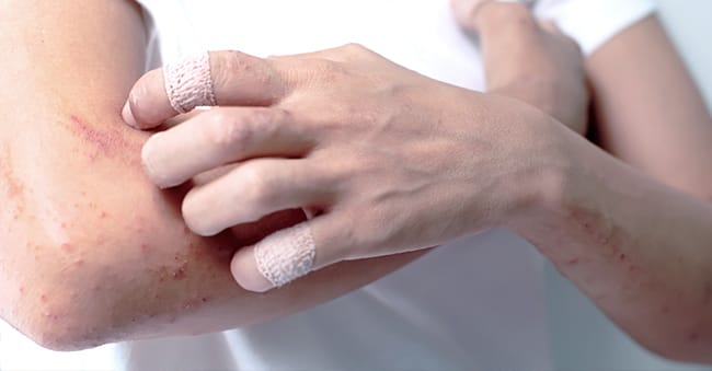 Eczema-affected skin showing redness and inflammation, available for treatment at Premier Clinic