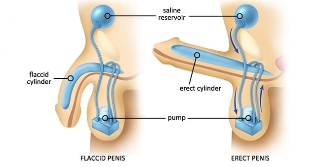 Erectile dysfunction