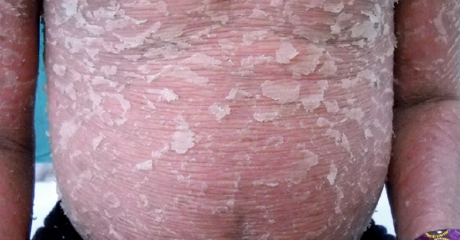 Erythrodermic Psoriasis