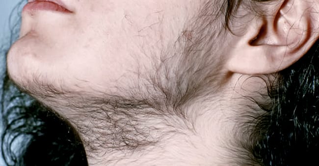 Excessive Hair Hirsutism