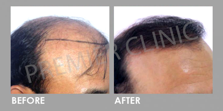 FUE Hairtransplant Before After