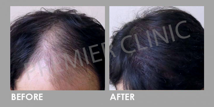FUE Hairtransplant Before After