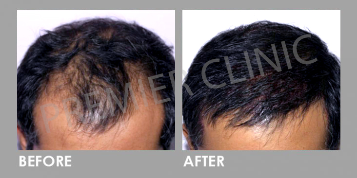FUE Hairtransplant Before After