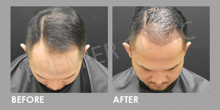 FUE Manson Ong Before After