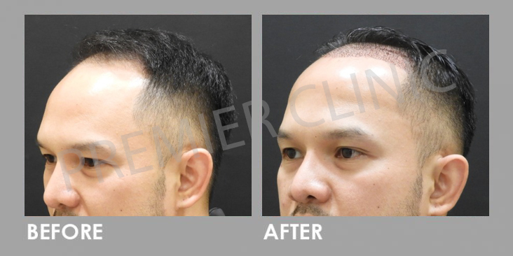 FUE Manson Ong Before After