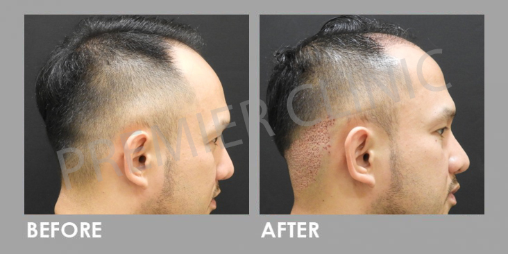 FUE Manson Ong Before After