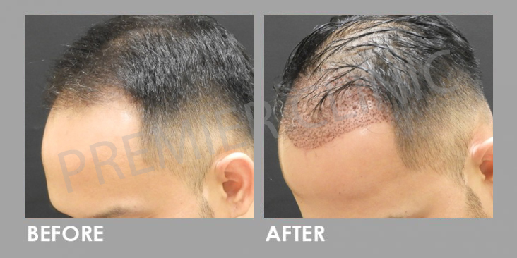 FUE Manson Ong Before After