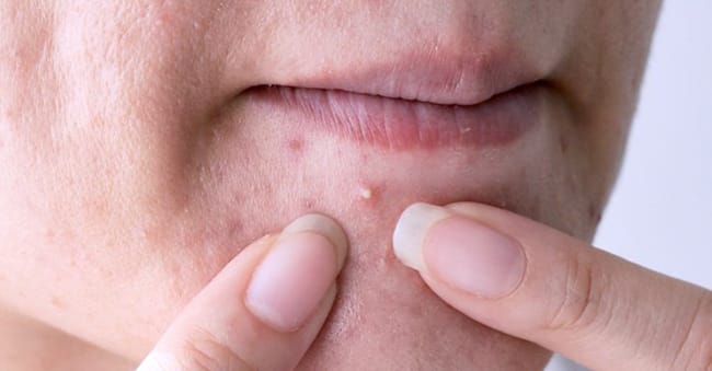 Facial Pores Chronic Acne