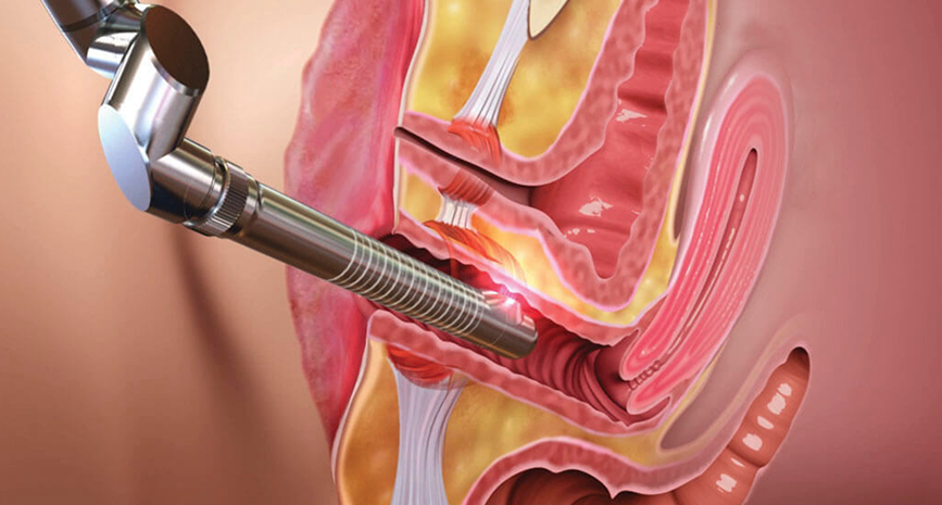 Laser Vagina Rejuvenation