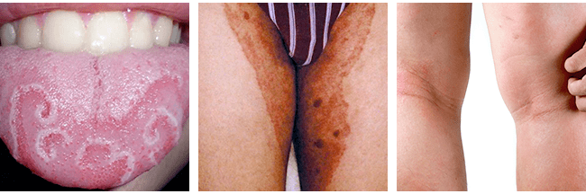 Fungal Infections Usually Appear