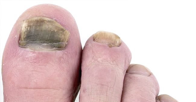 Fungal Nail Infection