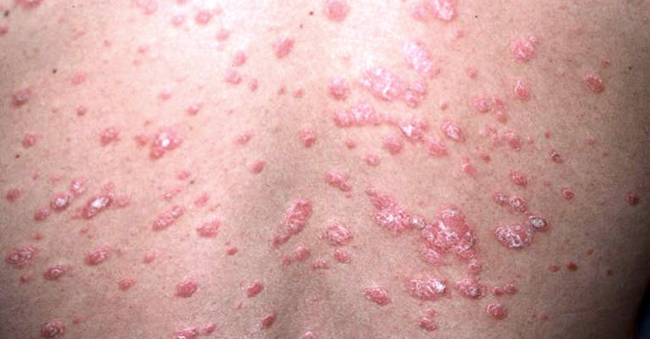 Guttate Psoriasis