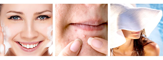 HOW TO PREVENT ACNE SCARRING