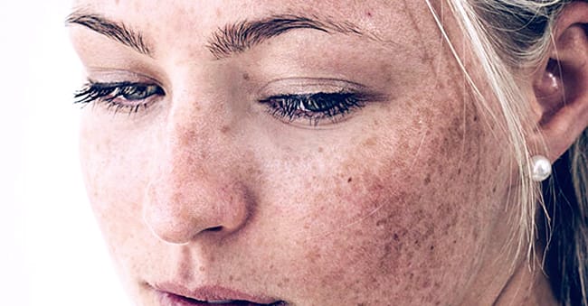 Hormonal Pigmentation