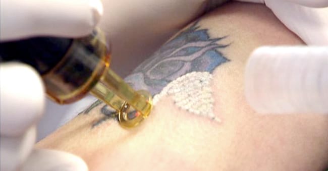 How Long Does it Take to Remove Tattoos