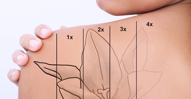 How Long Does-it Take to Remove Tattoos