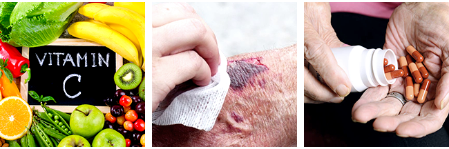 How to Prevent Herpes