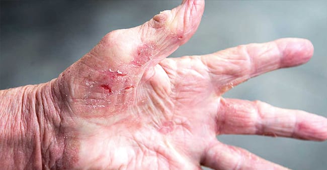 Interface Dermatitis Reaction