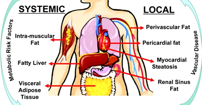 Intermuscular Fat