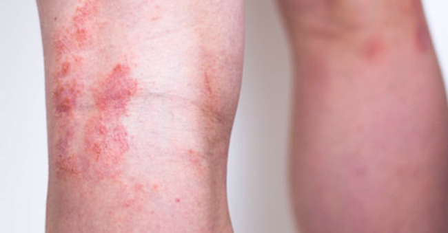 Inverse Psoriasis