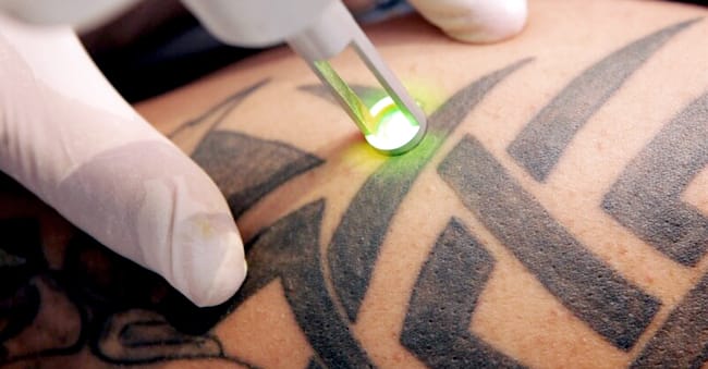 Is it Possible to Fully Remove Tattoos
