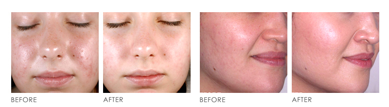 ED PHOTOTHERAPY before after
