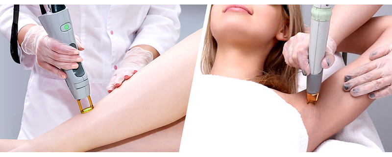 hair removal malaysia