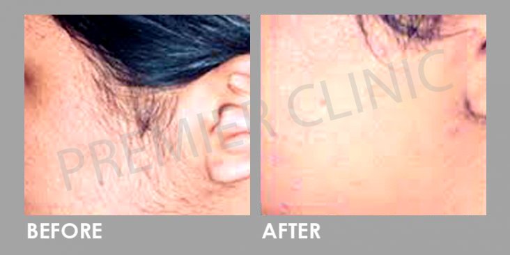 Laser Hair Removal Before After