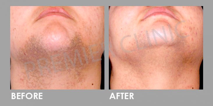 Laser Hair Removal Before After