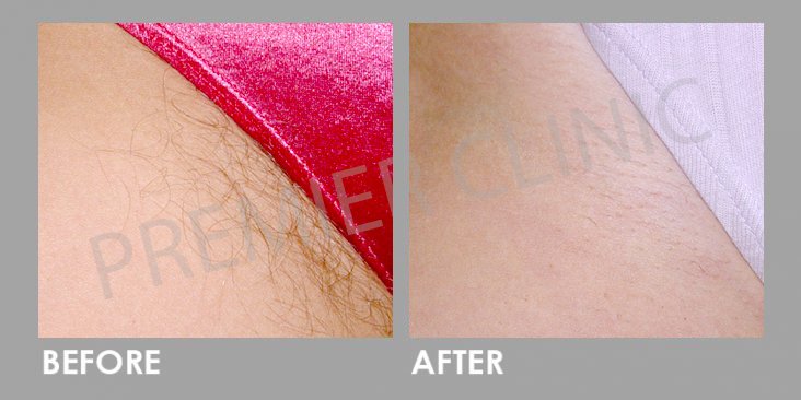 Laser Hair Removal Before After