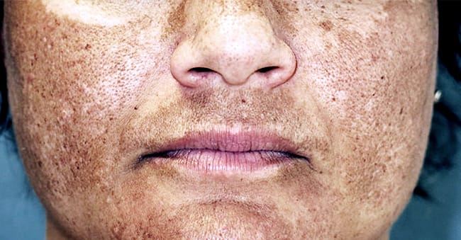 Melasma