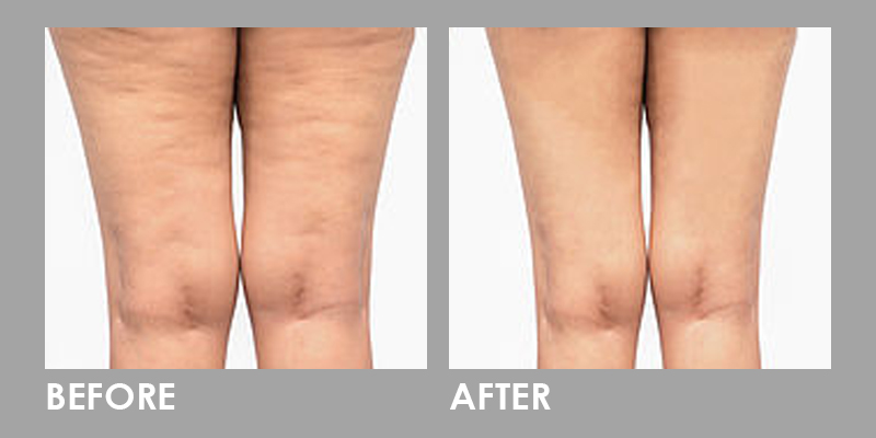 Fractional CO2 Laser