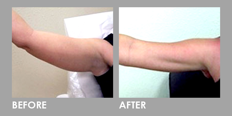 MesoLipo Fat Melting Injection