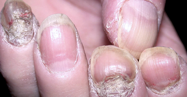 Nail Psoriasis