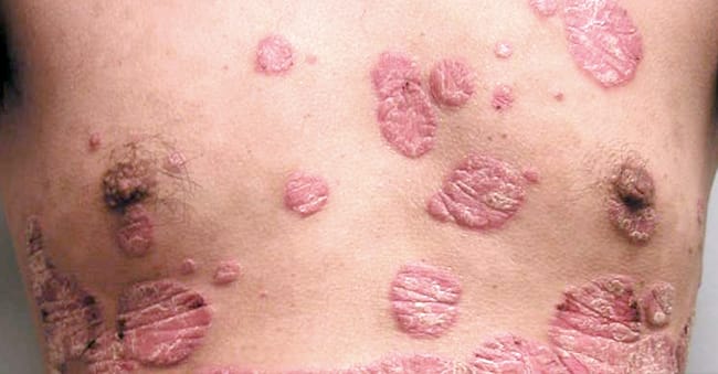 Neurodermatitis