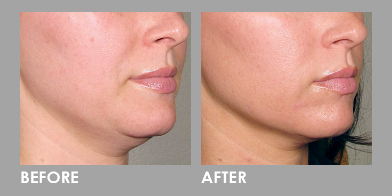 Non-Surgical Thread Lift